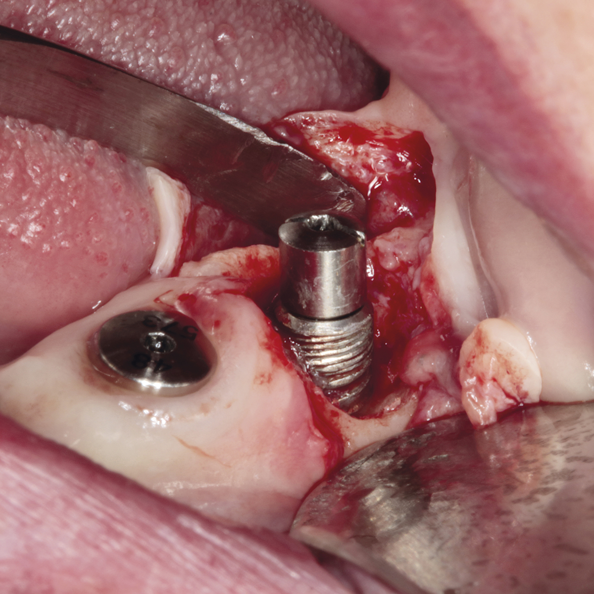 DENTAIDEXPERTISE - LOS RETOS DE LA PERIIMPLANTITIS